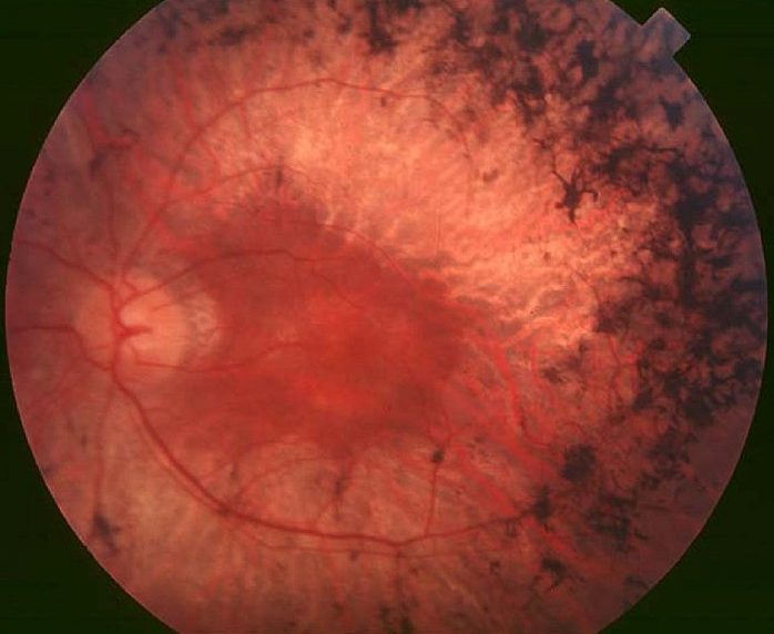 retinitis pigmentosa